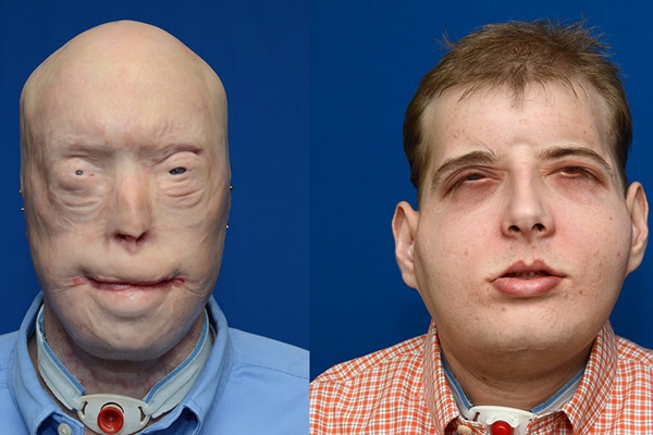 Der Vergleich vor und nach der Operation. Foto: NYU Langone