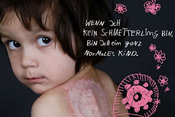 Aktion "Tag des brandverletzten Kindes". Foto: Gabriela Acklin